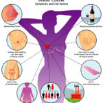 Acumpuntura en cáncer de pecho 28526858_l